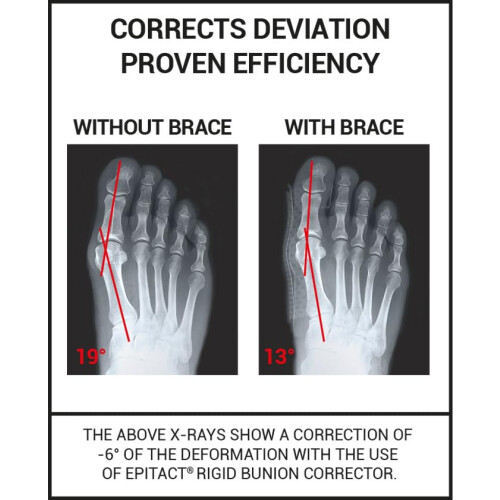 Epitact - Hallux Valgus (Bunion) Day Corrector - Size S 2