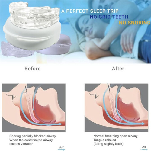 PC+EVA Adjustable Braces to Alleviate Grinding and Improve Sleep Tools