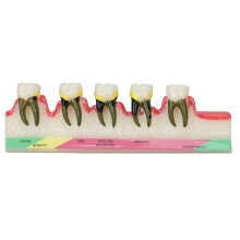 Educational Dental Tool, Demonstrates Gingivitis To Alveolar Resorption, Supports Study Teach And Professional Development