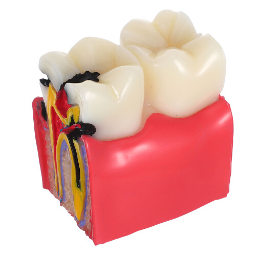 4Pcs Tooth Decay Comparative Anatomy Model Resin for Student Teaching 2