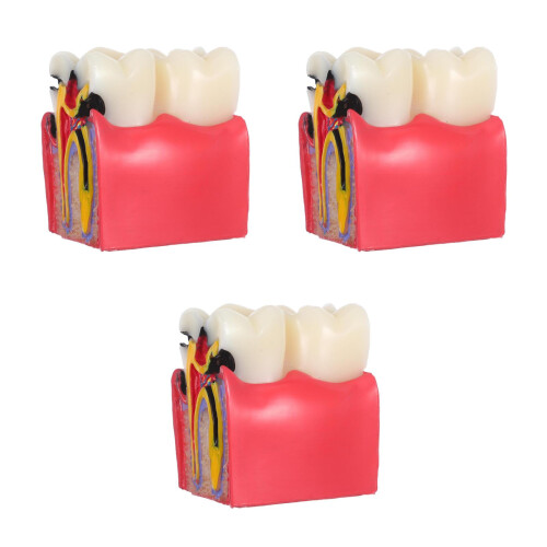 3St Heldere Caries Typodont Tool Voor Studenten En Tandartsen 2
