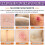 Silicone Scar Sheets Reusable Soft Breathable 2pcs 5