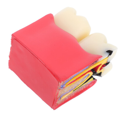 2Pièces Typodont Caries Résine Enseignement Patient Coloré 1