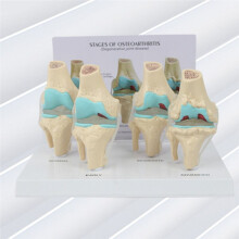 Kit del Ginocchio Modello Anatomico per Osteoartrite con Chiave Educativa Modello del Ginocchio In 4 Fasi Sussidi Didattici Ortopedici