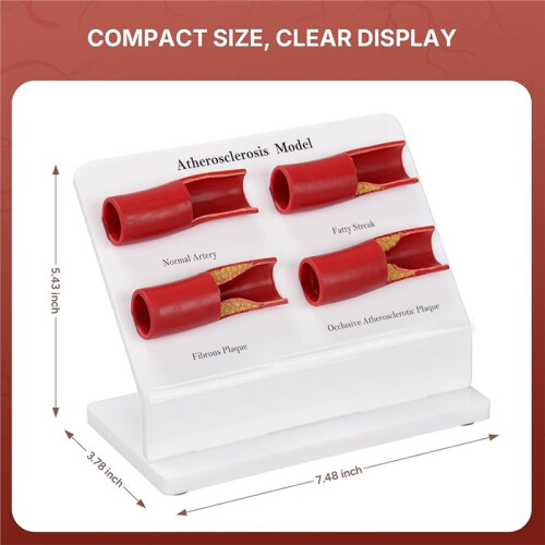 New Teaching Demonstration Model, Arterial Atherosclerosis Model, Vascular Model, Vascular Sclerosis Comparison Model 1