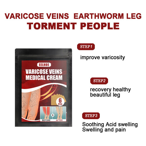 Varicose Veins Patch - Phlebitis & Vasculitis Relief 1