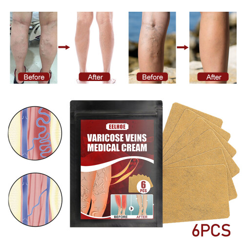 Varicose Veins Patch - Phlebitis & Vasculitis Relief 2