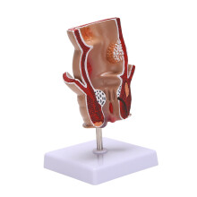 Anatomie Model Menselijke Rectale Aambei Laesie Model Aambei Fistel Fistel Kloof Pathologie Onderwijs Model