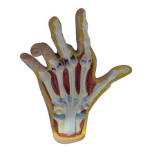 Osteoarthritis Hand Model, Model of Hand Pathology, Human Anatomy and Physiology Replica, Doctor'S Office Anatomy Model