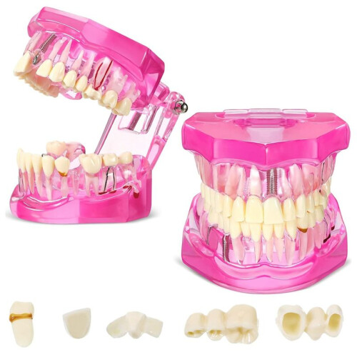Disease Teeth Model Dental Typodonts Implant Teeth Model with Removable Teeth Pathological Demonstration (,2 Pcs)