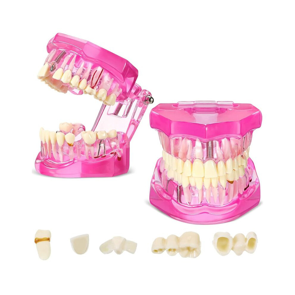 Disease Teeth Model Dental Typodonts Implant Teeth Model With Removable Teeth Pathological Demonstration (,2 Pcs) 4713552235580