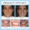 Silicone Denture Set for Teeth Protection 7