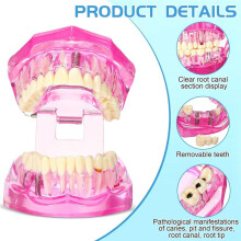Model Zębów Chorobowych Typodonty Dentystyczne Implant Zębów Model z Wyjmowanymi Zębami Demonstracja Patologiczna (Różowy, 2 Szt)