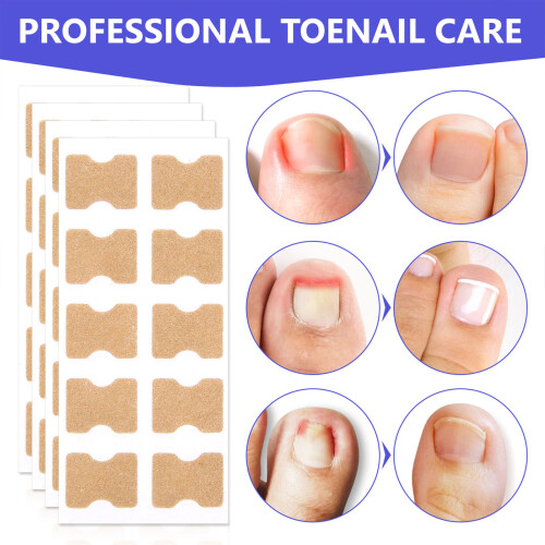 50pcs Ingrown Toenail Stickers - Pedicure Fixer Tool 1