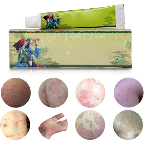Anti-itch cream, herbal cream for allergic dermatitis 2