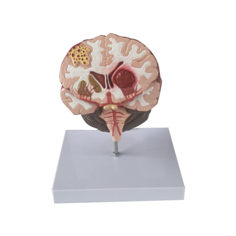 Tlily Human Brain Disease Model - Brain Pathology Brainstem Hemorrhage Medical Teaching Model - Human Brain Anatomy Model