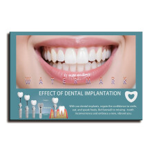 Dental Implant Canvas Poster - Tooth Restoration Pictures for Dental Clinics - Modern Dentist Wall Art for Office Decoration