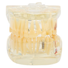 Modèle de dents pathologiques transparent à taille réelle avec composants détachables, modèle pédagogique dentaire présentant des canaux