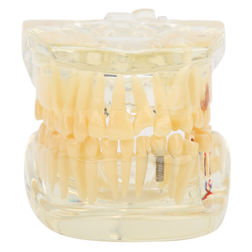 Natural Size Transparent Pathological Teeth Model with Detachable Components, Dental Teaching Model Featuring Root Canals and Dental Implants for