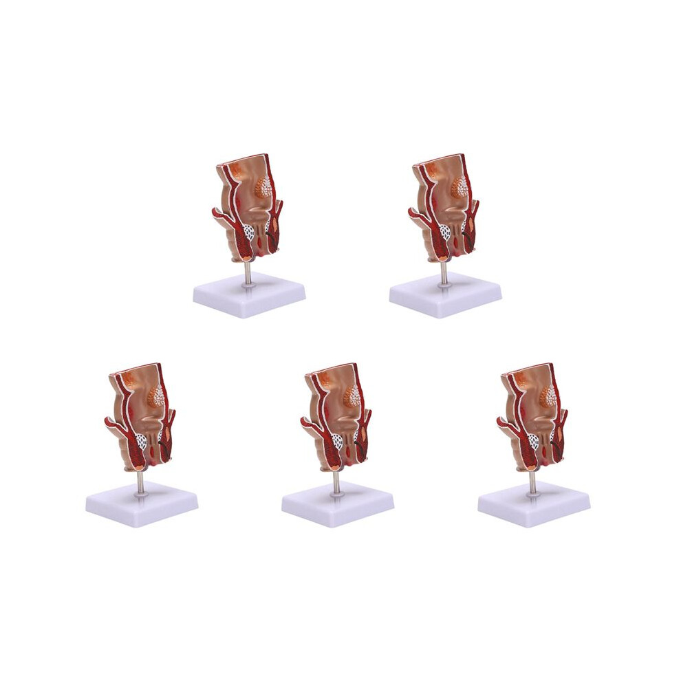 Unisex 5X Anatomy Model Human Rectal Hemorrhoid Lesion Model Hemorrhoid Fistula Fistula Fissure Pathology Teaching Model