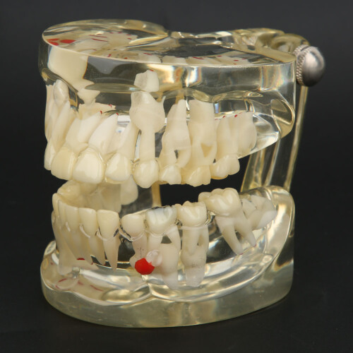 Transparent Dental Implant Teeth Model, Visual Understanding Pathological Demonstration Transparent Design Teeth Model with Full Visibility 1