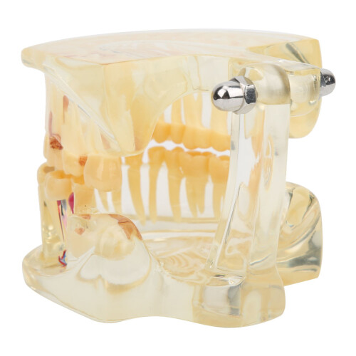 Natural Size Transparent Pathological Teeth Model with Detachable Components, Dental Teaching Model Featuring Root Canals and Dental Implants for 1