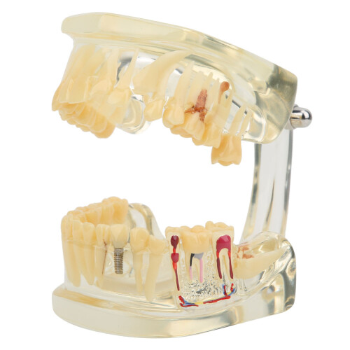 Natural Size Transparent Pathological Teeth Model with Detachable Components, Dental Teaching Model Featuring Root Canals and Dental Implants for 2