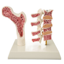 Modello Vertebrale di Osteoporosi per scopi didattici in plastica realistica e durevole