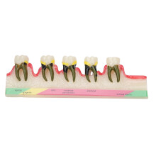 Dental Hygiene Teaching Aid, Periodontal Disease Demonstrator, Portable Design For Easy Transportation And Storage, High Quality Resin Ensuring