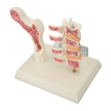 Osteoporosis Vertebral Model for Educational Purpose Realistic Durable Plastic