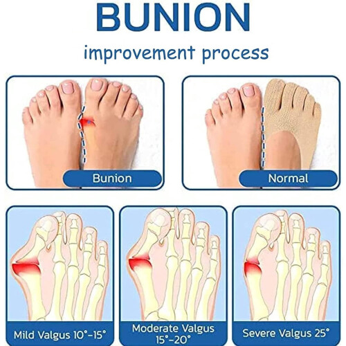 Κάλτσες Orthoes για ανακούφιση από κότσια για γυναίκες – 5 ζευγάρια ορθοπεδικές 2