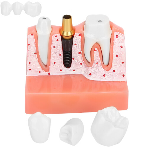 High-quality Material Demonstrative Implant Model, Removable Crown For Visual Explanation In Patient Demonstrations And Educational Programs 1