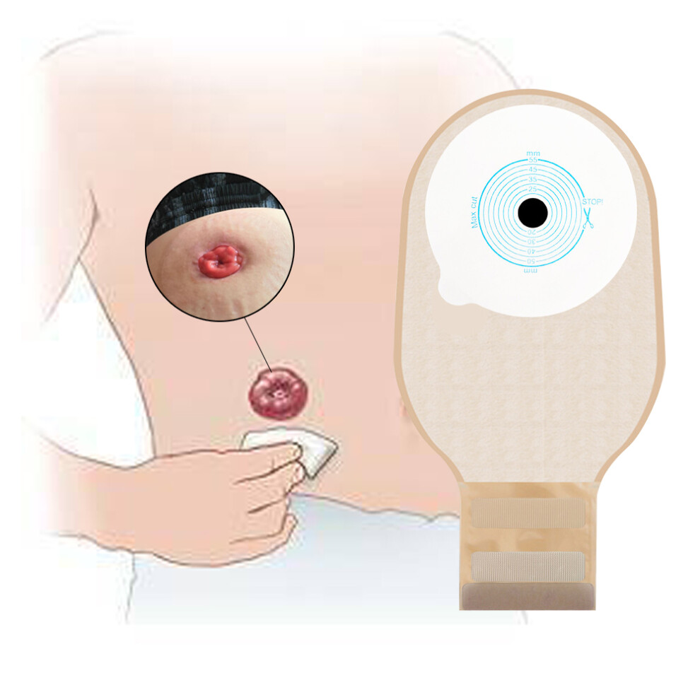 Versatile Ostomy Pouch, Offering Customization And Odor Control