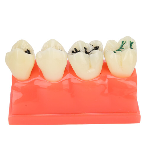 Dental Teaching Aid, Gingiva Visible, Detachable Crowns For Enhanced Learning Experiences 1