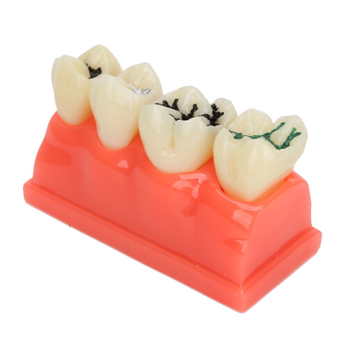 Dental Teaching Aid, Gingiva Visible, Detachable Crowns For Enhanced Learning Experiences 2