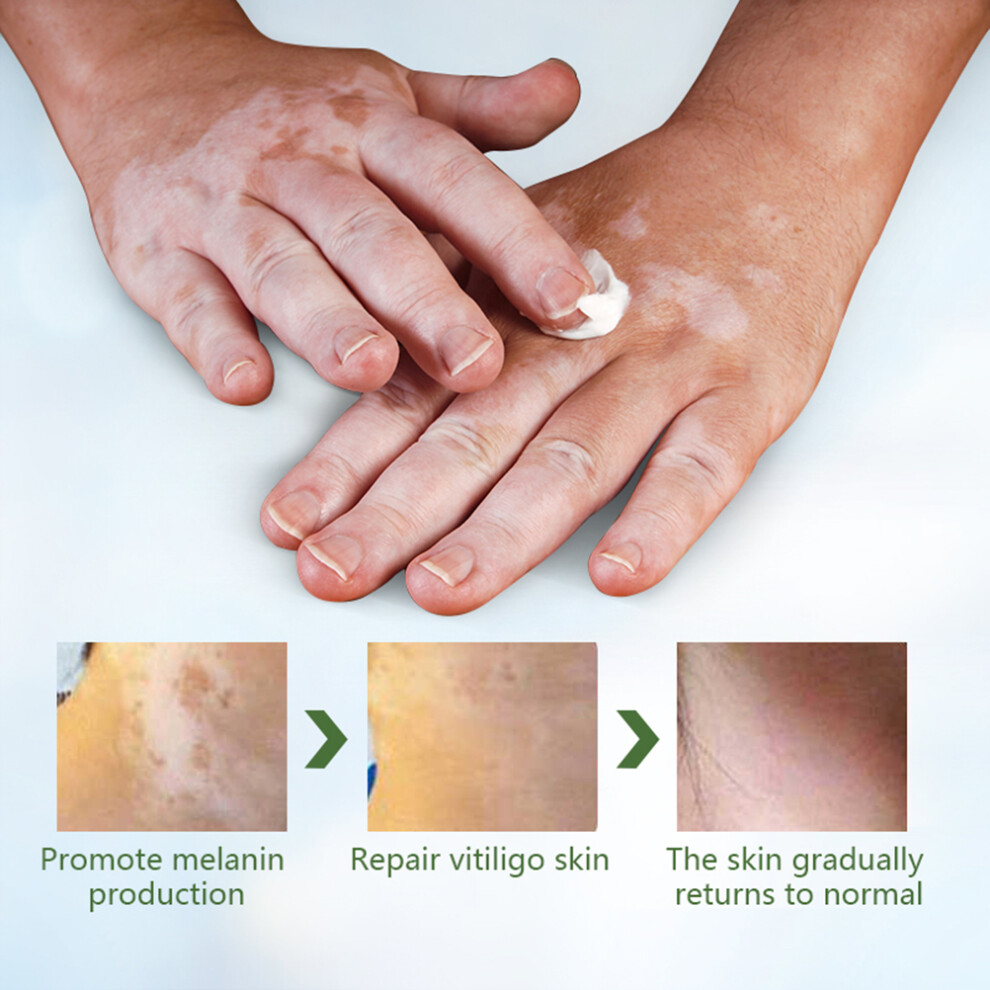 White/Cream Vitiligo Spot Skin 20G Pigment & Melanin Plaster, 33G Pack