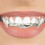 (Silver) Gold Vampire Fangs Grill for Halloween 1
