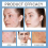 (5pcs) Crema anti-acne per donne e uomini - Detergente e idratante profondo 5