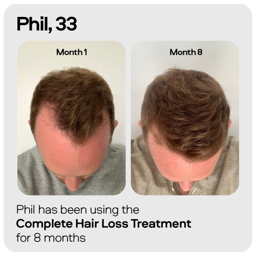 Sons Minoxidil 5% & Derma Roller, 3 Months 2