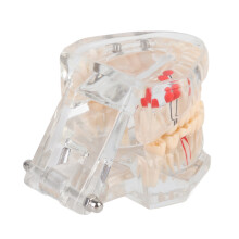 Educational Dental Caries Model, Clear Gingival, Portable 9x7cm