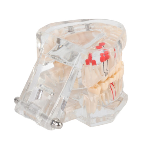 Educational Dental Caries Model, Clear Gingival, Portable 9x7cm