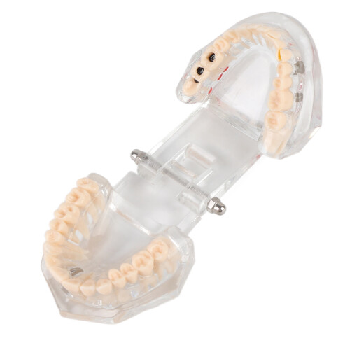 Educational Dental Caries Model, Clear Gingival, Portable 9x7cm 2