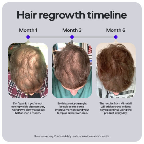 Sons Minoxidil 5% & Strengthening Shampoo, 1 Month 1