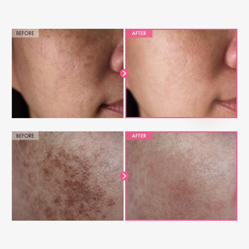 TOSOWOONG Arbutin 7% + Tranexamic Acid 1