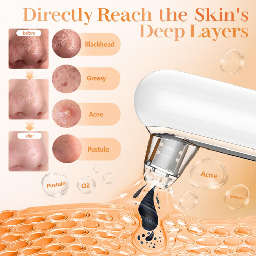 Yccu Blackhead Remover Vacuum 4 Suction 2
