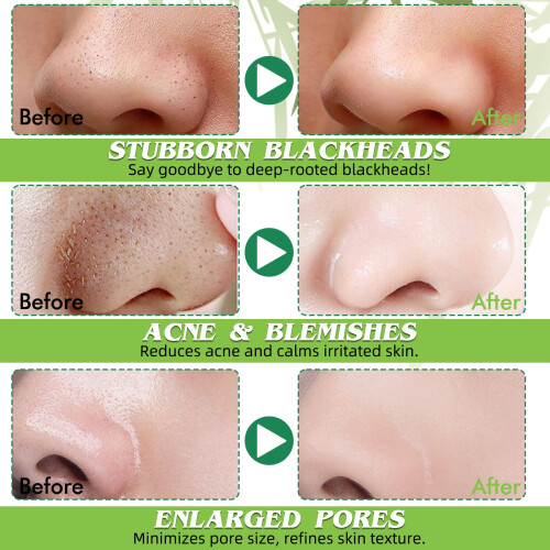 Blackhead Remover Strips, 10 PCS Individually 1