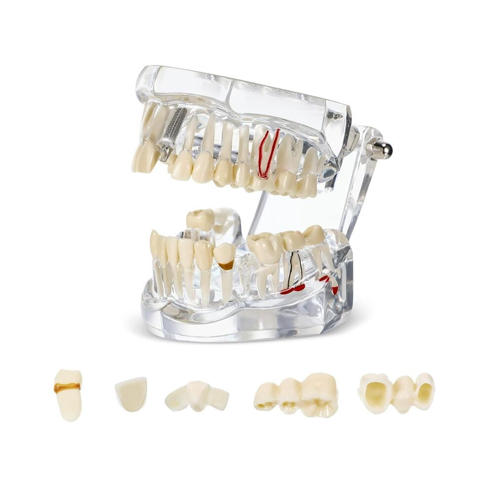 Tlily Disease Teeth Model Dental Typodonts Implant Teeth Model With Removable Teeth Dentist Standard Tooth Demonstration