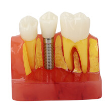 Dental Implant Model Crown Bridge Demonstration for Doctors & Patients