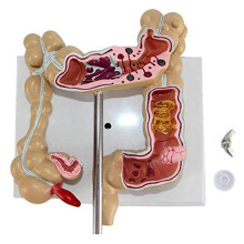 Kolonpatologisk Kolorektal Cancermodell Tjocktarmsmodell Gastrointestinal Anatomisk Modell