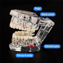 Transparent Disease Teeth Model with Dental Implant Bridge, Dental Model for Patient and Dental Student Education